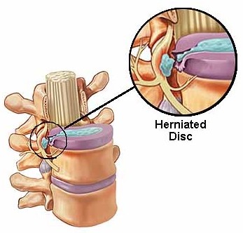 disc herniated nerve pinched car accident herniation injury radiculopathy accidents damage cervical neck disk hernia pain bulging discs hoffmannpersonalinjury cause